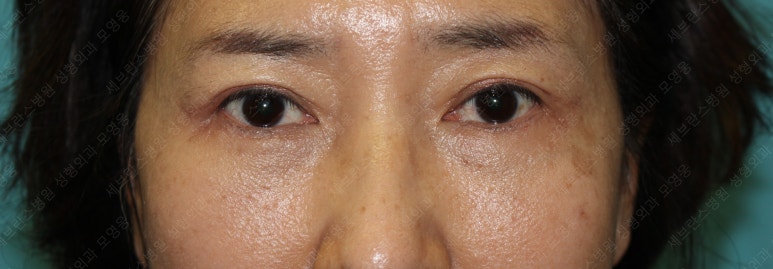 55세 여성, 상안검 및 하안검 성형술 증례 (55/F Upper & lower blepharoplasty) 관련 이미지 20