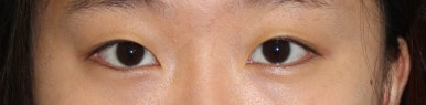 17세 여성, 쌍꺼풀+앞트임(DEO+Medial epicanthoplasty) 관련 이미지 52