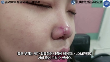 21세 여성 코 지름 1cm 점 제거수술 : 나선피판술(Spiral Flap) 수술전~5달 경과. (+쌍꺼풀수술, 코필러) 관련 이미지 69