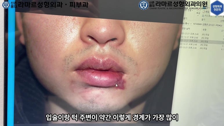 개에 물려 입술 1/3이 뜯긴 19세 남자분 치료 및 흉터 성형수술& 레이저 후기....! 관련 이미지 30