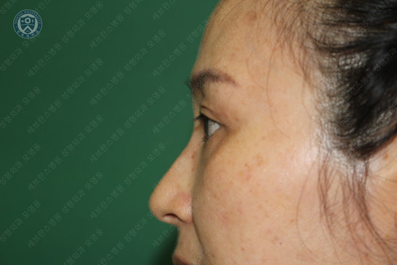 49세 여성, 토안이 있는 중년여성의 상안검성형술 (49/F, Upper blepharoplasty with lagophthalmos correction& LP) 관련 이미지 29