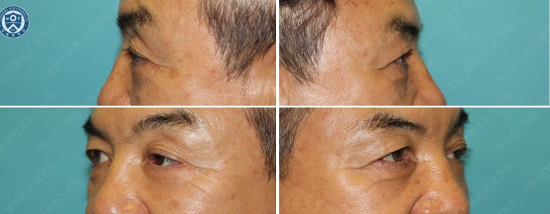68세 남성, 하안검 성형술 및 안검외반 교정 증례(68/M Lower blepharoplasty & Ectropion correction with triamcinolone) 관련 이미지 24