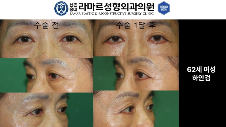 30대~80대 눈 수술 케이스 : 하안검성형술 전후 사진 모음 관련 이미지 40