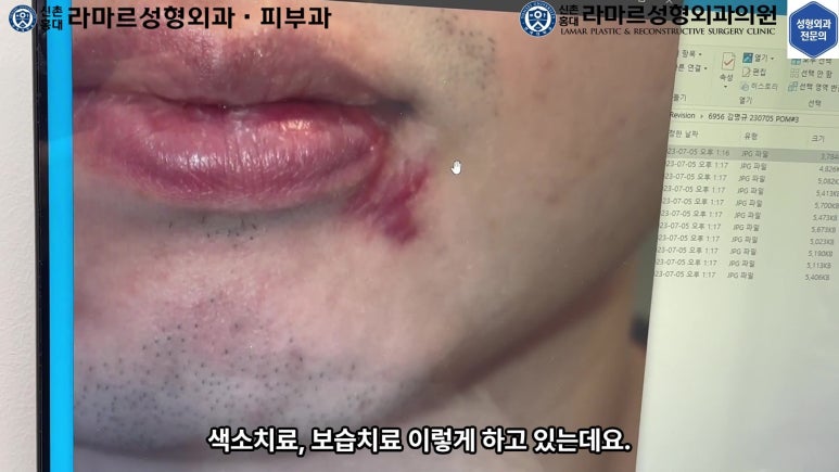 개에 물려 입술 1/3이 뜯긴 19세 남자분 치료 및 흉터 성형수술& 레이저 후기....! 관련 이미지 46