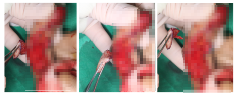 수지 말단부 절단에 시행한 동측 역행성 유경피판술 증례 (Homodigital Reverse Island Flap for Fingertip Amputation) 관련 이미지 7