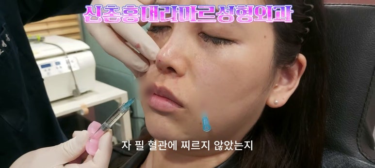 30대 여성 팔자필러 시술: 팔자주름과 안전이별 하는 법 관련 이미지 6