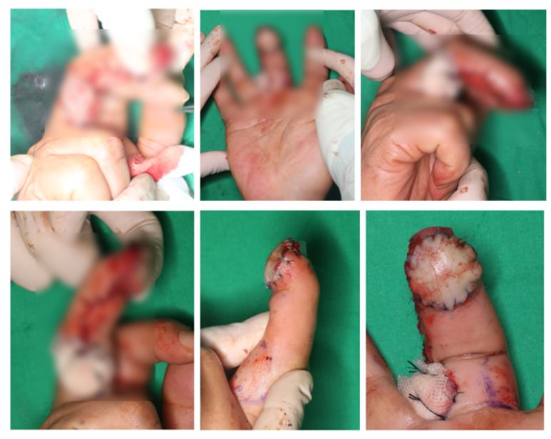 수지 말단부 절단에 시행한 동측 역행성 유경피판술 증례 (Homodigital Reverse Island Flap for Fingertip Amputation) 관련 이미지 9