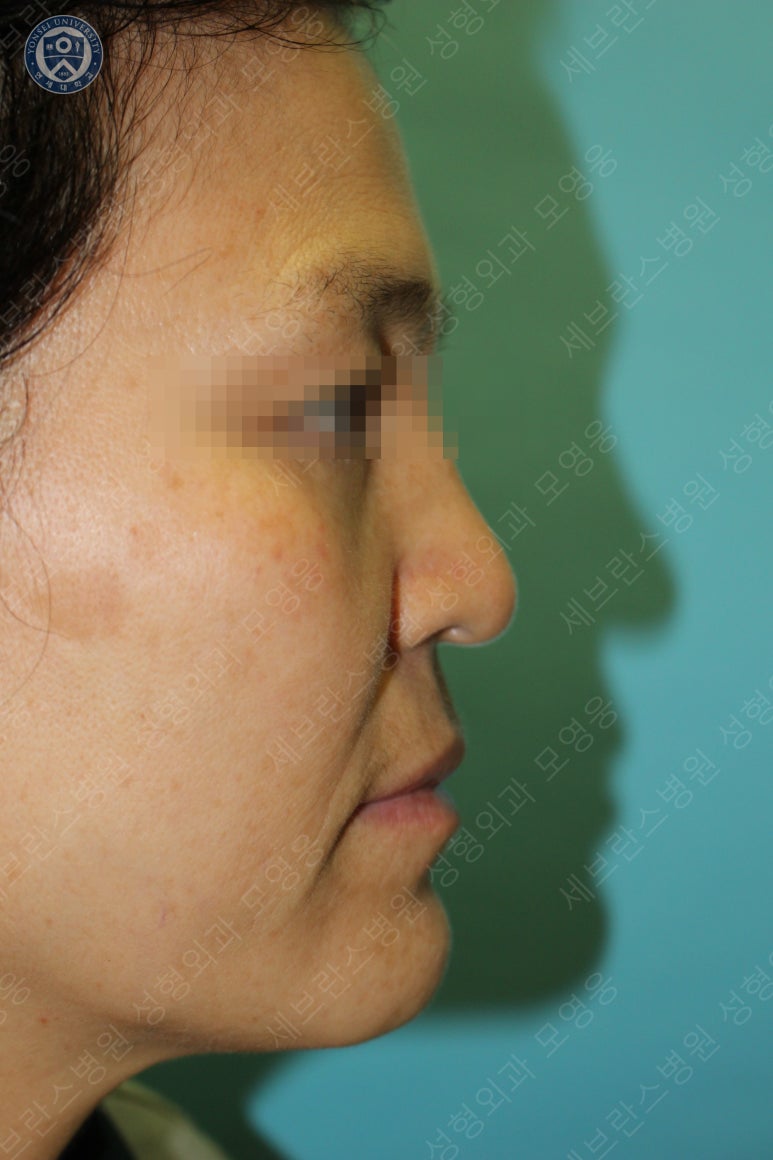 55세 여성, 이중평면 안면거상(55/F, Dual-plane full facelift) 관련 이미지 10