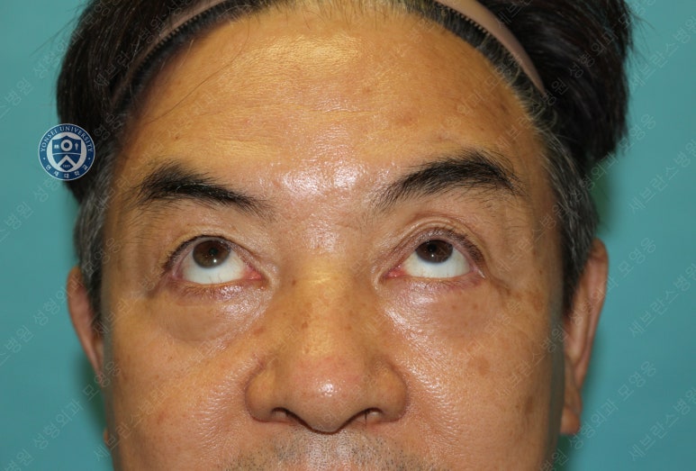 68세 남성, 하안검 성형술 및 안검외반 교정 증례(68/M Lower blepharoplasty & Ectropion correction with triamcinolone) 관련 이미지 18