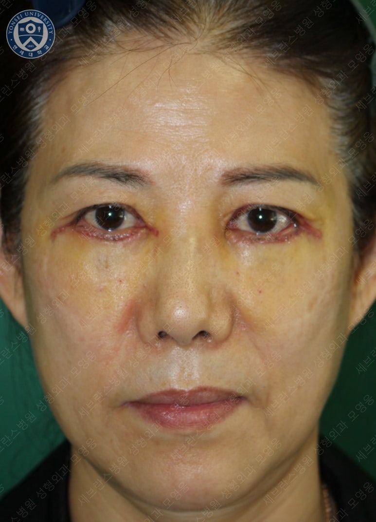 59세 여성, 그레이브스 안병증이 있는 돌출눈 중년 여성 하안검 성형술 (Lower blepharoplasty in Graves 관련 이미지 9