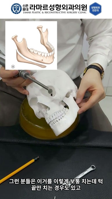 성형수술의 끝판! 성형외과 윤곽수술을 알려드립니다. 저희병원에서 사용하는 수술기구, 그리고 윤곽3종 모의수술....!! 관련 이미지 56