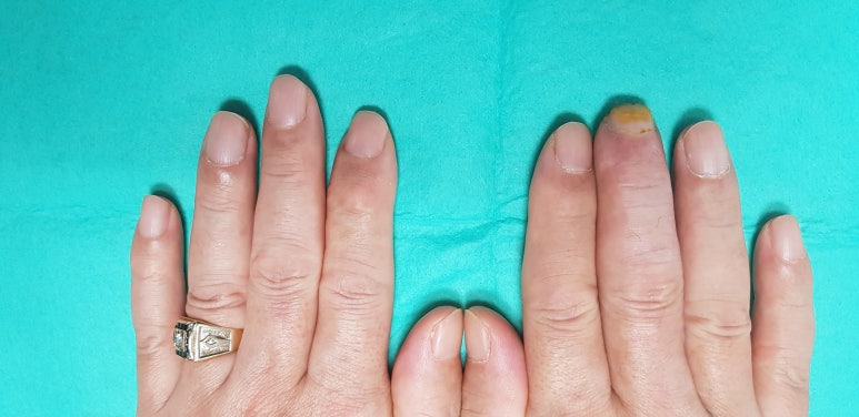 수지 말단부 절단에 시행한 동측 역행성 유경피판술 증례 (Homodigital Reverse Island Flap for Fingertip Amputation) 관련 이미지 11