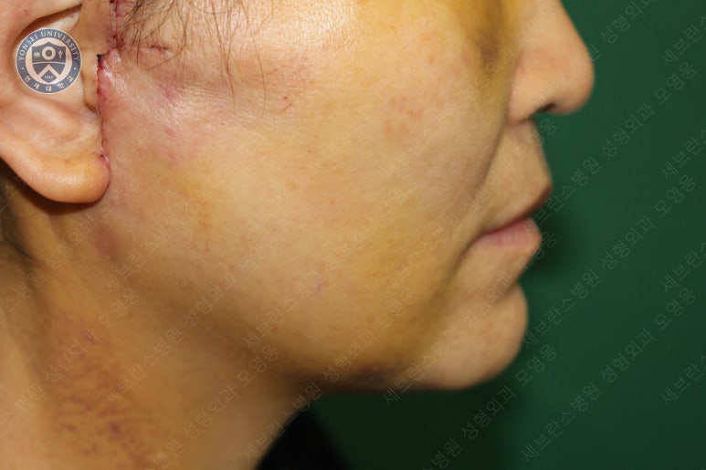 55세 여성, 이중평면 안면거상(55/F, Dual-plane full facelift) 관련 이미지 34