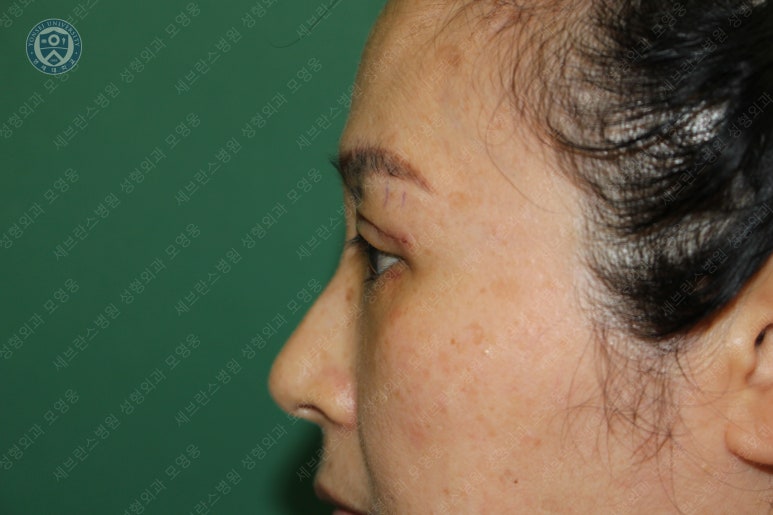 49세 여성, 토안이 있는 중년여성의 상안검성형술 (49/F, Upper blepharoplasty with lagophthalmos correction& LP) 관련 이미지 20