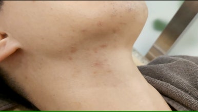 모영웅 대표원장 해초필링(FCR peeling) 피부관리영상...! 멍게피부가 사과피부가 되는 과정을 보여드립니다^^ 관련 이미지 43