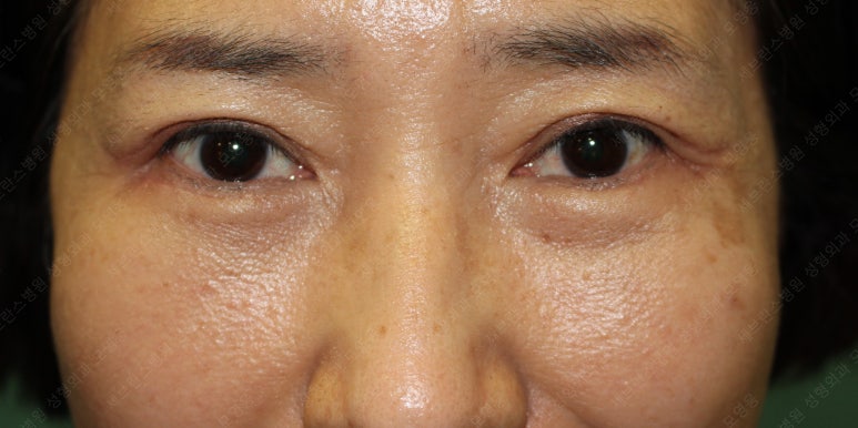 55세 여성, 상안검 및 하안검 성형술 증례 (55/F Upper & lower blepharoplasty) 관련 이미지 28