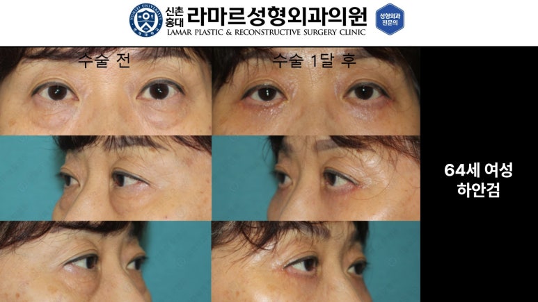 30대~80대 눈 수술 케이스 : 하안검성형술 전후 사진 모음 관련 이미지 20