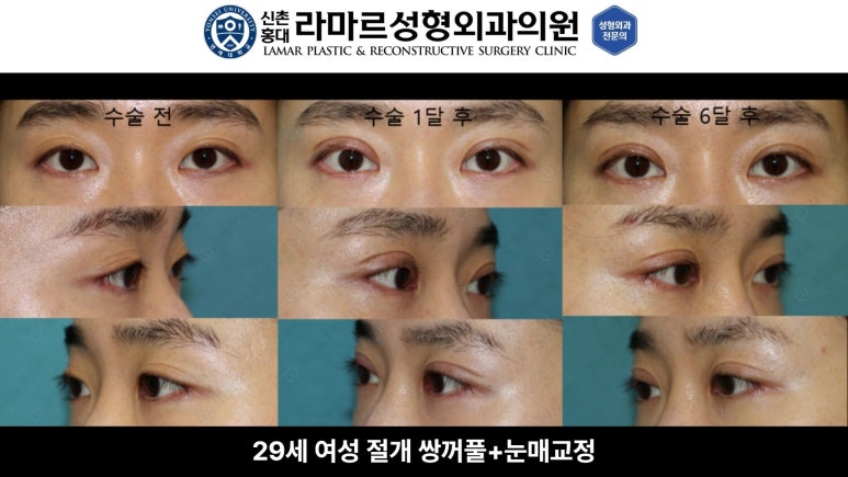 10대~30대 눈 수술 케이스 : 대표원장님 쌍꺼풀 전후 사진 모음 관련 이미지 14