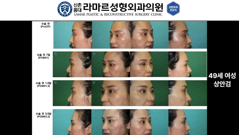 40대~80대 눈 수술 케이스 : 상안검성형술 전후 사진 모음 관련 이미지 12