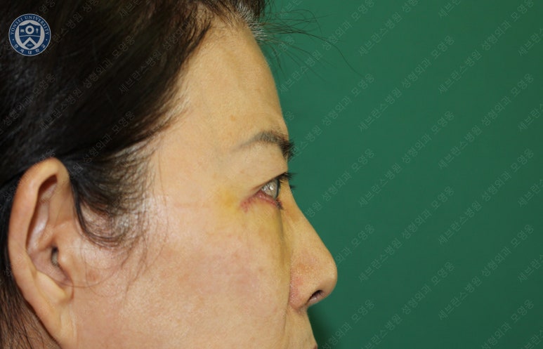 59세 여성, 그레이브스 안병증이 있는 돌출눈 중년 여성 하안검 성형술 (Lower blepharoplasty in Graves 관련 이미지 16