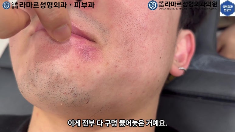 개에 물려 입술 1/3이 뜯긴 19세 남자분 치료 및 흉터 성형수술& 레이저 후기....! 관련 이미지 80