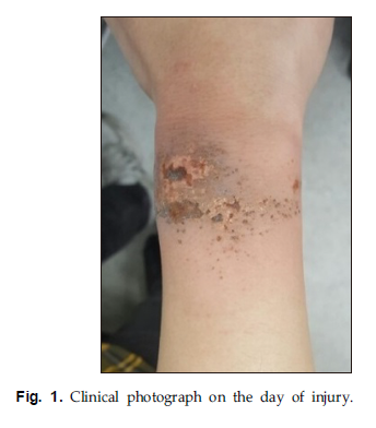 JKBS-Deep Second Degree Burn of Ferrous Chloride in a Worker at a Wastewater Treatment Facility 관련 이미지 3