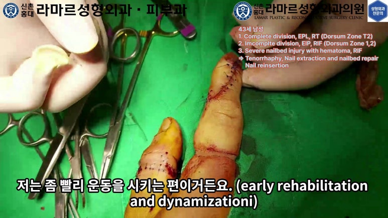 손가락 힘줄 손상 및 열상, 손톱 바닥 열상 처치 (Extensor tendon repair and nailbed injury treatment) 관련 이미지 33