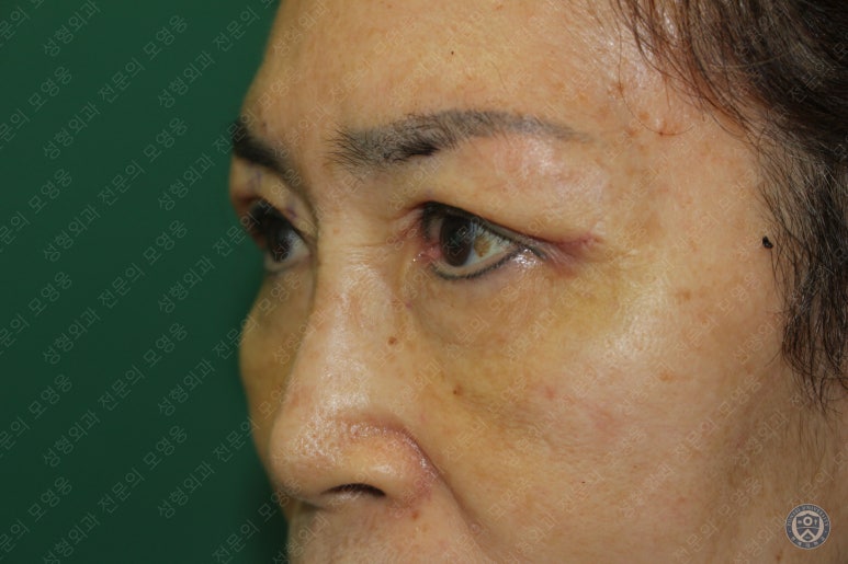 64세 여성 상안검성형술+눈매교정 (64/F Upper blepharoplasty with ptosis correction) 관련 이미지 15
