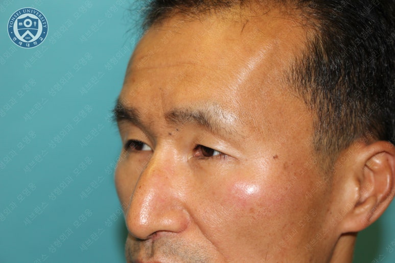 남자눈성형: 무쌍눈매교정 (Blephroptosis correction-levator aponeurosis advancement) 관련 이미지 17