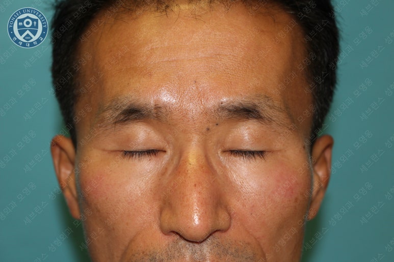남자눈성형: 무쌍눈매교정 (Blephroptosis correction-levator aponeurosis advancement) 관련 이미지 12