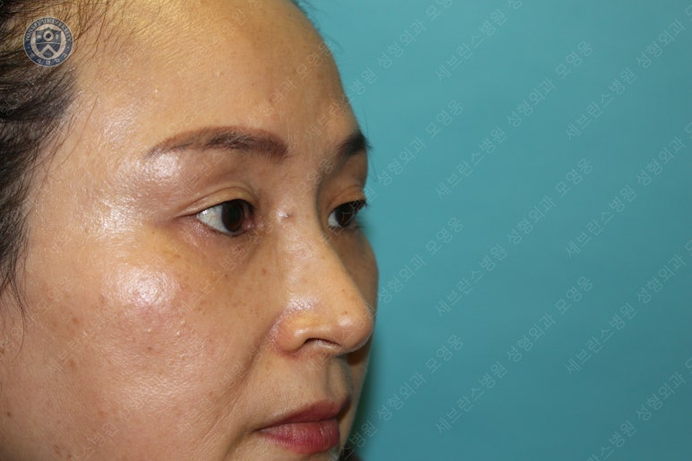 49세 여성, 토안이 있는 중년여성의 상안검성형술 (49/F, Upper blepharoplasty with lagophthalmos correction& LP) 관련 이미지 8