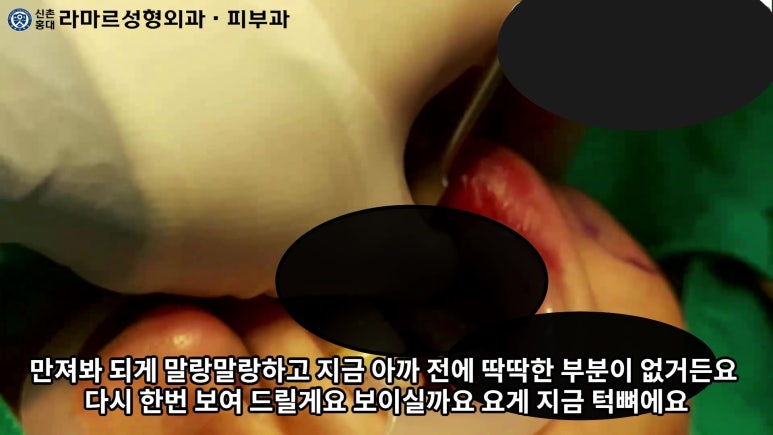 파라핀 필러 입 안 절개로 흉터없이 빼내기! 관련 이미지 67