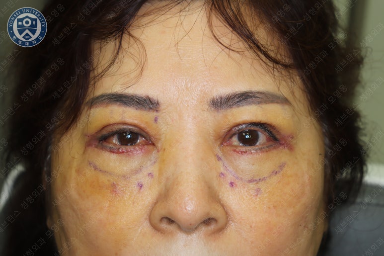 60세 여성, 상안검 및 하안검 성형술 증례 (60/F Upper & lower blepharoplasty) 관련 이미지 12