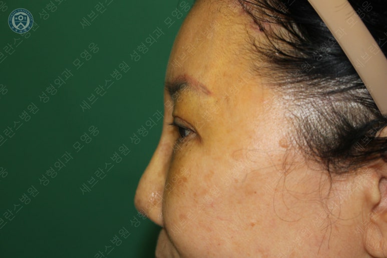71세 여성, 이마거상술과 이마축소술 (71/F, Forehead lift and reduction) 관련 이미지 24