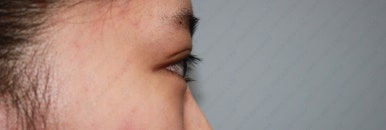 17세 여성, 쌍꺼풀+앞트임(DEO+Medial epicanthoplasty) 관련 이미지 18