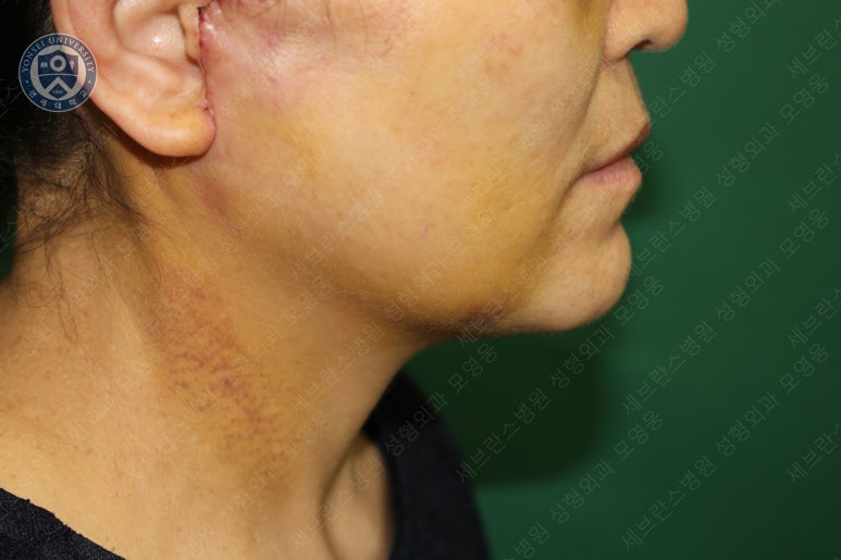 55세 여성, 이중평면 안면거상(55/F, Dual-plane full facelift) 관련 이미지 35