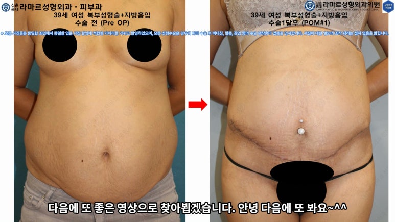 '복부성형술+지방흡입(Abdominoplasty+PAL)' 으로 뱃살 끝장내기! 관련 이미지 63
