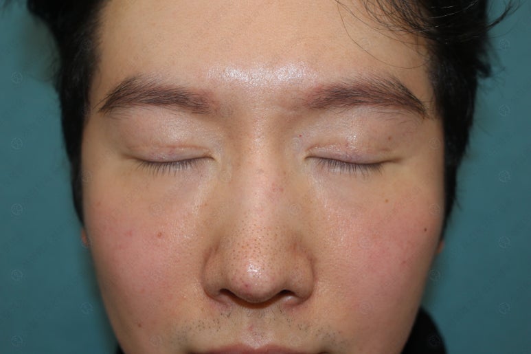 29세 남자, 소시지 쌍꺼풀 두줄따기로 낮추기 (쌍꺼풀 재수술) 관련 이미지 14