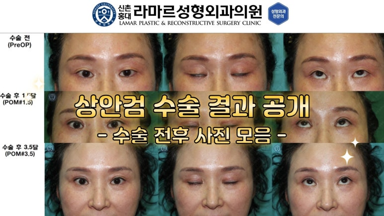 40대~80대 눈 수술 케이스 : 상안검성형술 전후 사진 모음 관련 이미지 5