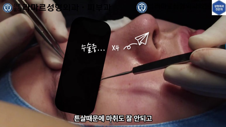 29세 남자, 소시지 쌍꺼풀 두줄따기로 낮추기 (쌍꺼풀 재수술) 관련 이미지 27