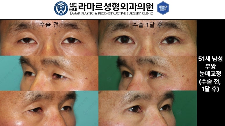 40대~80대 눈 수술 케이스 : 상안검성형술 전후 사진 모음 관련 이미지 6