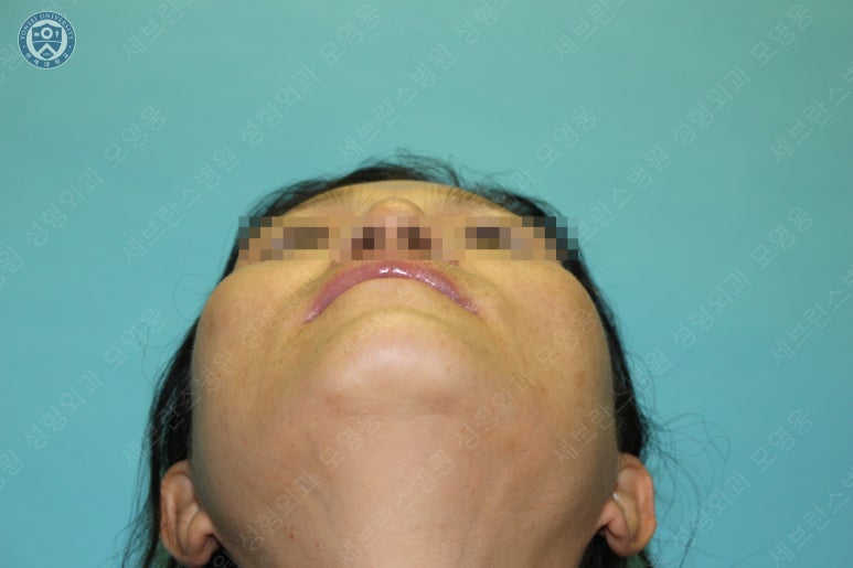 55세 여성, 이중평면 안면거상(55/F, Dual-plane full facelift) 관련 이미지 12