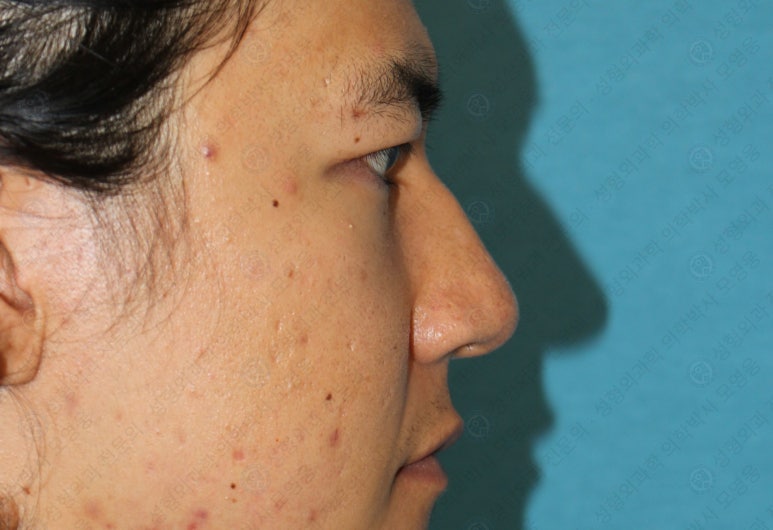 27세 남성 무쌍(속쌍)눈매교정 (27/M Ptosis correction with double lid plasty) 관련 이미지 37