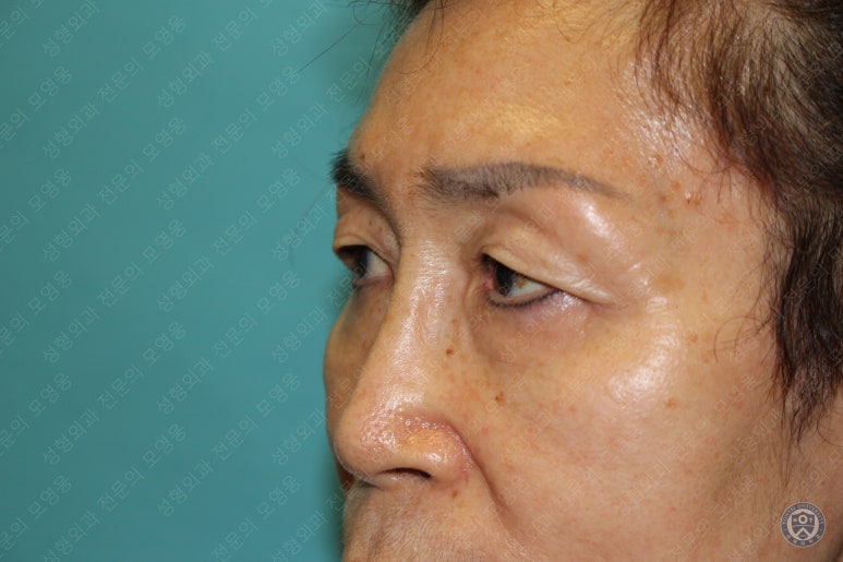 64세 여성 상안검성형술+눈매교정 (64/F Upper blepharoplasty with ptosis correction) 관련 이미지 7