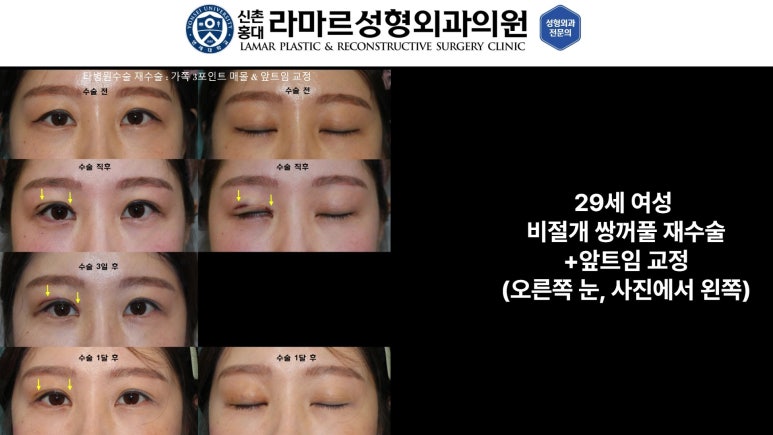 10대~30대 눈 수술 케이스 : 대표원장님 쌍꺼풀 전후 사진 모음 관련 이미지 23