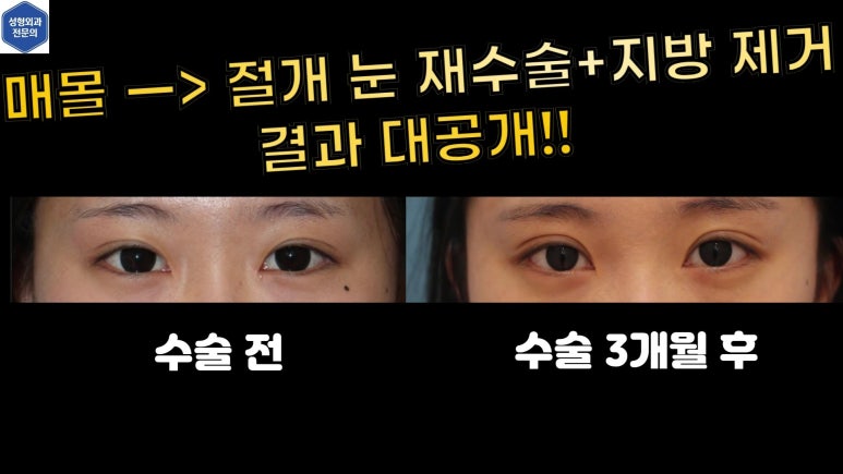 매몰 쌍꺼풀 풀고 절개쌍꺼풀로 바꾸는 쌍꺼풀 재수술!! 관련 이미지 5