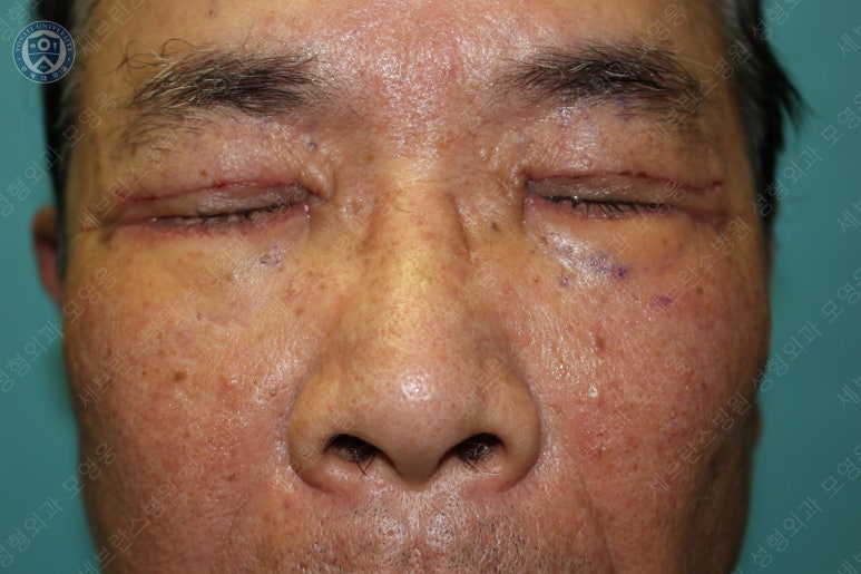 67세 남성, 상&middot;하안검성형술 및 안검하수교정 (67/M, Upper &  lower blepharoplasty with ptosis correction) 관련 이미지 22
