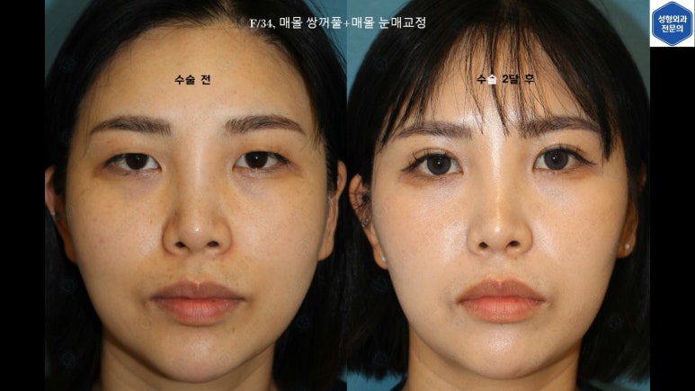 30대 여성 "쌍꺼풀+눈매교정" 상담, 디자인, 수술 전체 과정, 결과, 경과 모두 공개합니다. 관련 이미지 90