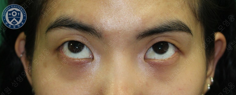 28세 여성, 눈밑지방재배치(눈밑지, 28/F Transconjunctival septal fat redraping-internal fixation technique) 관련 이미지 5