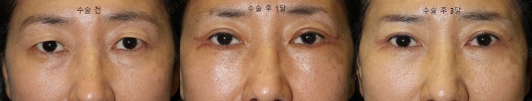 55세 여성, 상안검 및 하안검 성형술 증례 (55/F Upper & lower blepharoplasty) 관련 이미지 31